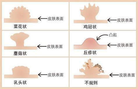 龜頭花|什麼是菜花或尖銳濕疣？完整了解菜花症狀與治療